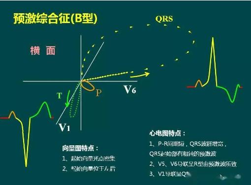 预激综合征要怎样通过公务员体检？这份攻略快来收藏！