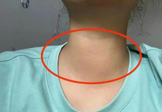 公务员体检哪些甲状腺问题会导致体检不合格？