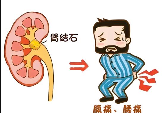 结石会影响公务员体检结果吗？一文读懂结石与体检标准